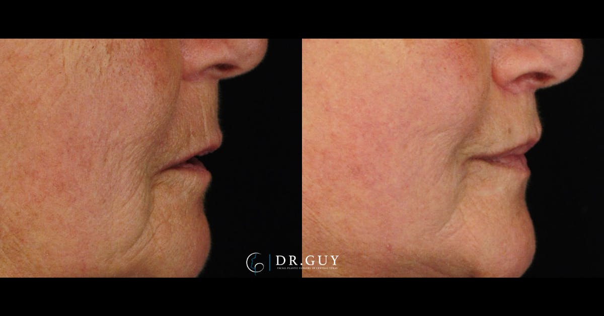 Lip Lift Before & After Gallery - Patient 286293 - Image 2