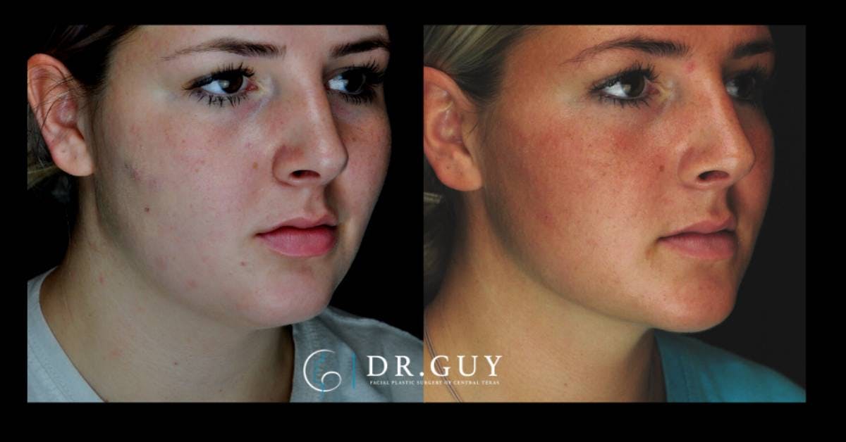 Neck Liposuction Before & After Gallery - Patient 862909 - Image 4