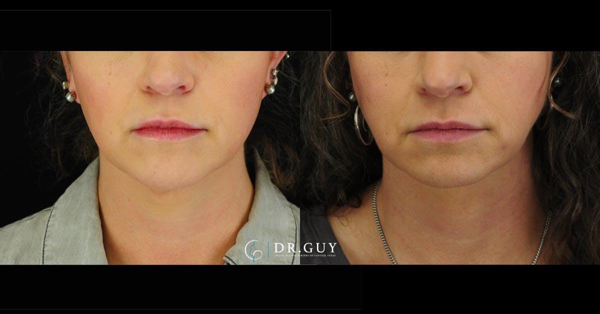 FaceTite Before & After Gallery - Patient 198911 - Image 3