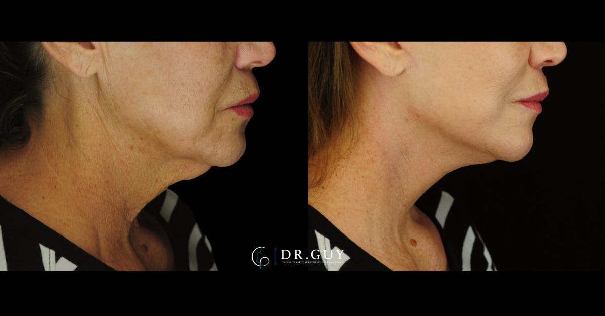 Mini Facelift Before & After Gallery - Patient 410394 - Image 5