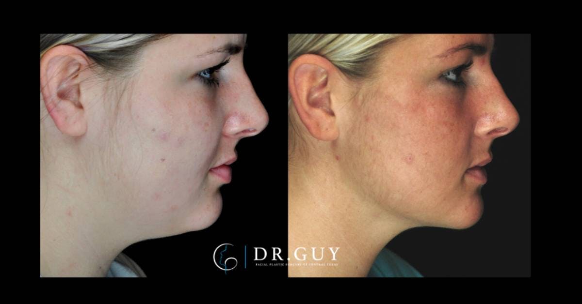 Neck Liposuction Before & After Gallery - Patient 862909 - Image 5