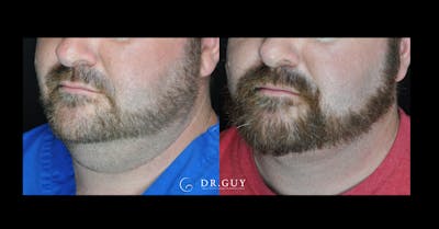 MyEllevate Before & After Gallery - Patient 322164 - Image 1