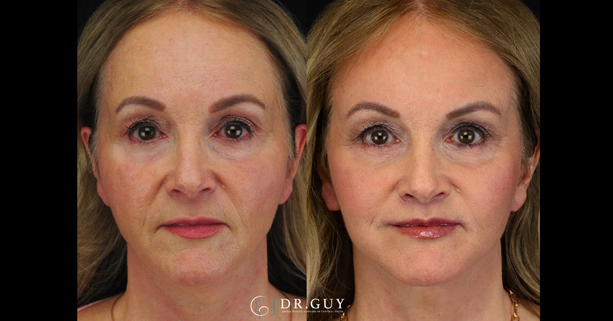 Lip Lift Before & After Gallery - Patient 376573 - Image 1