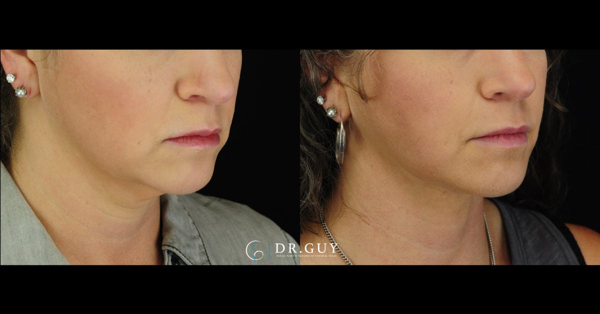 FaceTite Before & After Gallery - Patient 198911 - Image 4