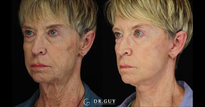 Mini Facelift Before & After Gallery - Patient 108337 - Image 1