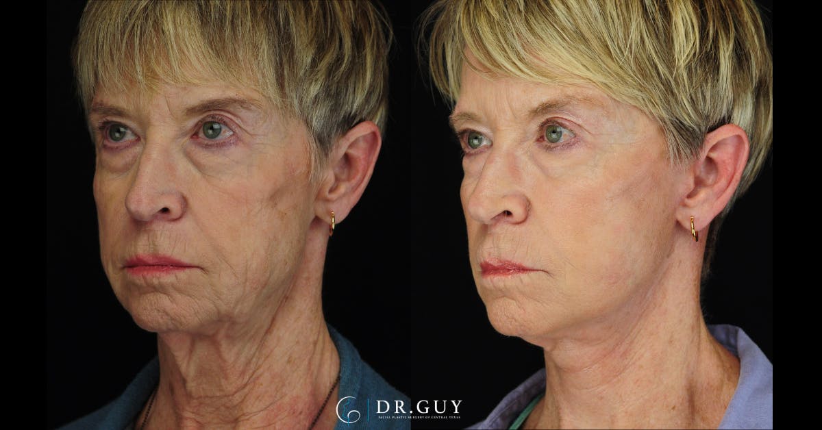 Mini Facelift Before & After Gallery - Patient 108337 - Image 1