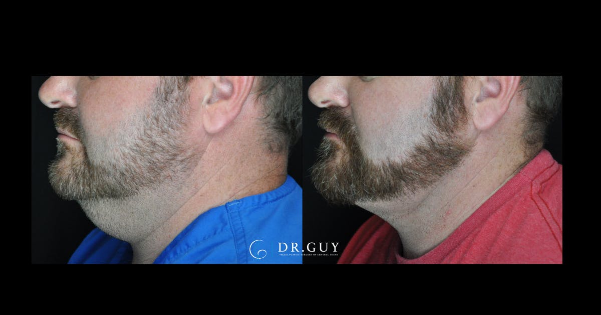 MyEllevate Before & After Gallery - Patient 322164 - Image 2