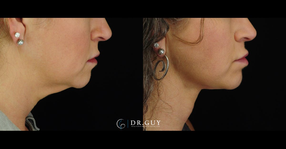 FaceTite Before & After Gallery - Patient 198911 - Image 5