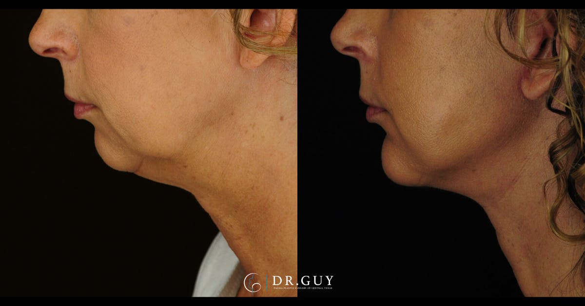 Chin Before & After Gallery - Patient 666945 - Image 4