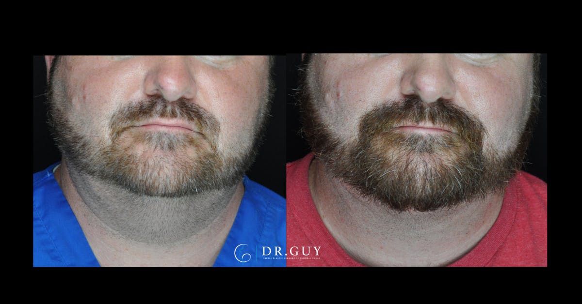 MyEllevate Before & After Gallery - Patient 322164 - Image 3