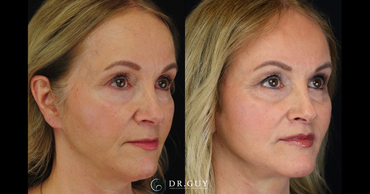Lip Lift Before & After Gallery - Patient 376573 - Image 3