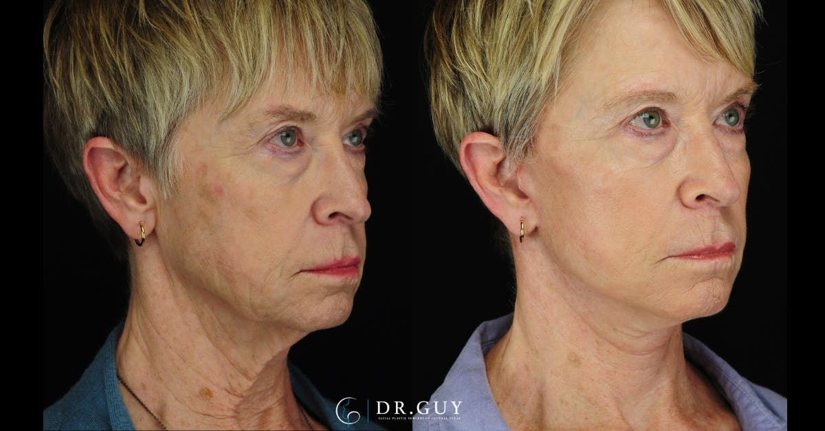 Mini Facelift Before & After Gallery - Patient 108337 - Image 2