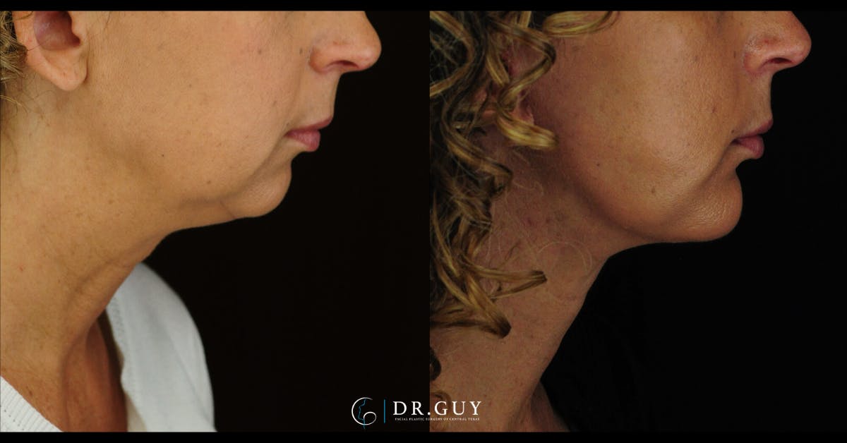 Chin Before & After Gallery - Patient 666945 - Image 5