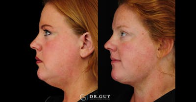 FaceTite Before & After Gallery - Patient 194834 - Image 1