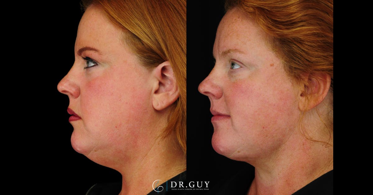 FaceTite Before & After Gallery - Patient 194834 - Image 1