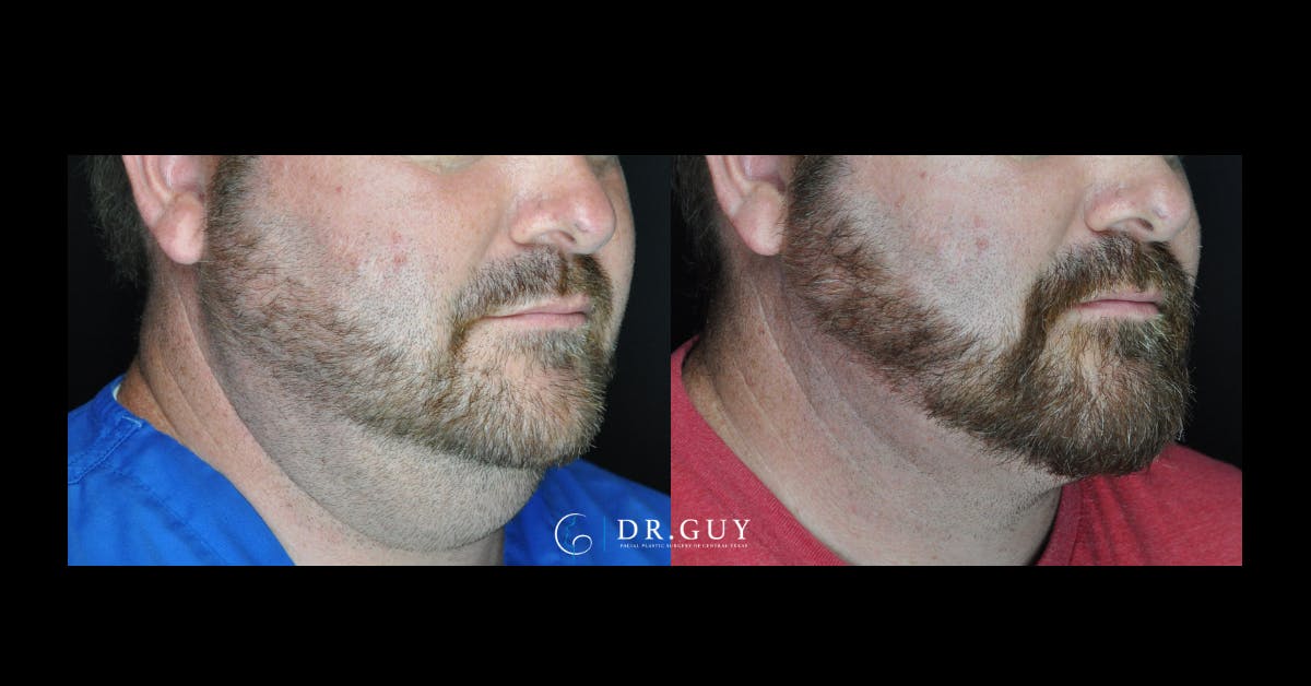 MyEllevate Before & After Gallery - Patient 322164 - Image 4