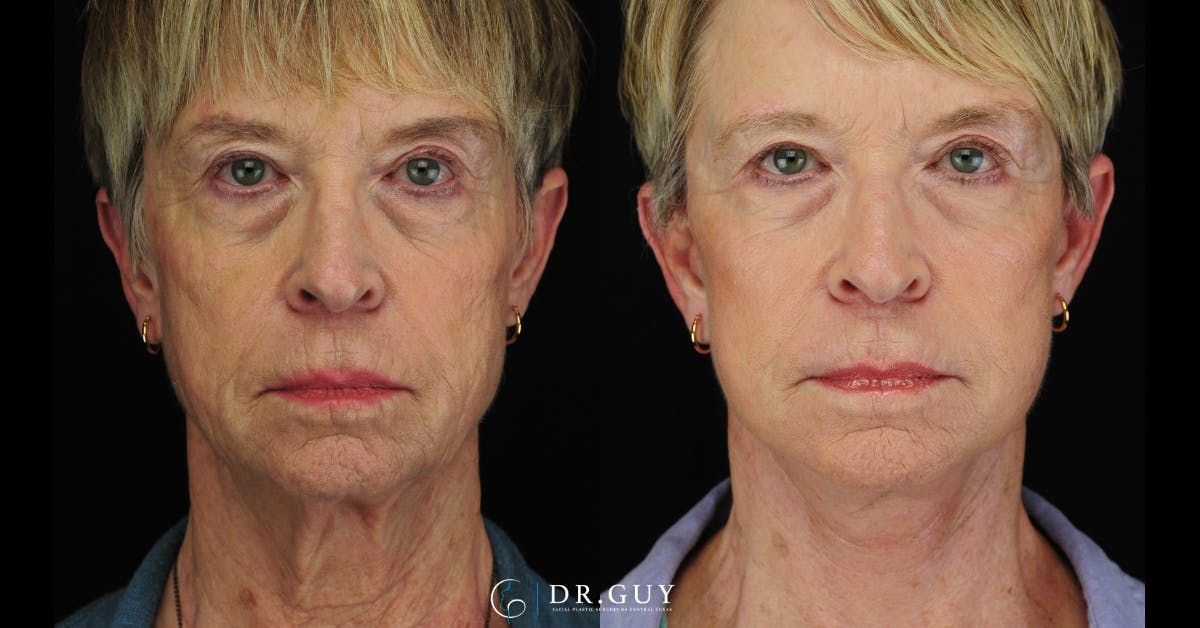 Mini Facelift Before & After Gallery - Patient 108337 - Image 3