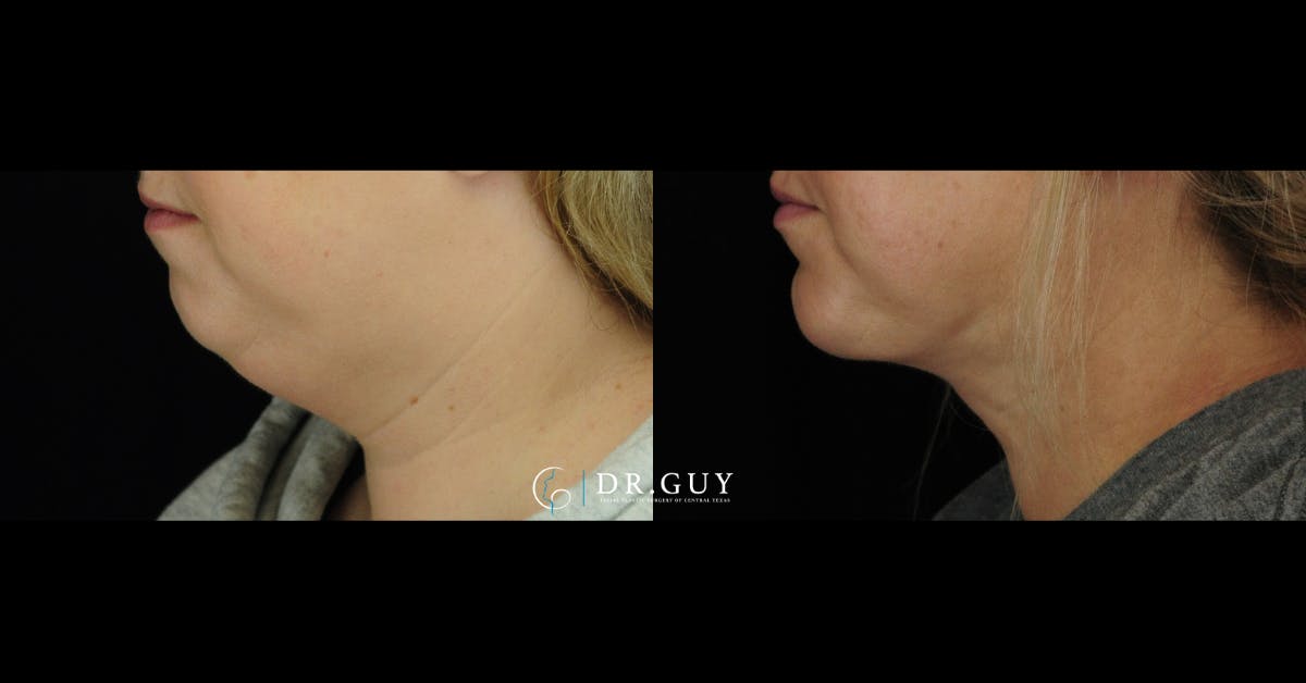 Chin Before & After Gallery - Patient 127249 - Image 1
