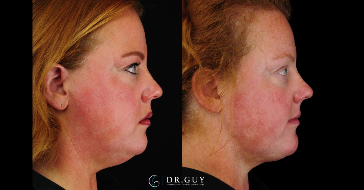 FaceTite Before & After Gallery - Patient 194834 - Image 2