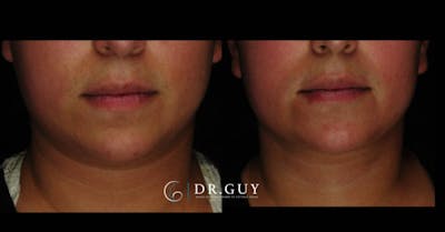 MyEllevate Before & After Gallery - Patient 803412 - Image 1