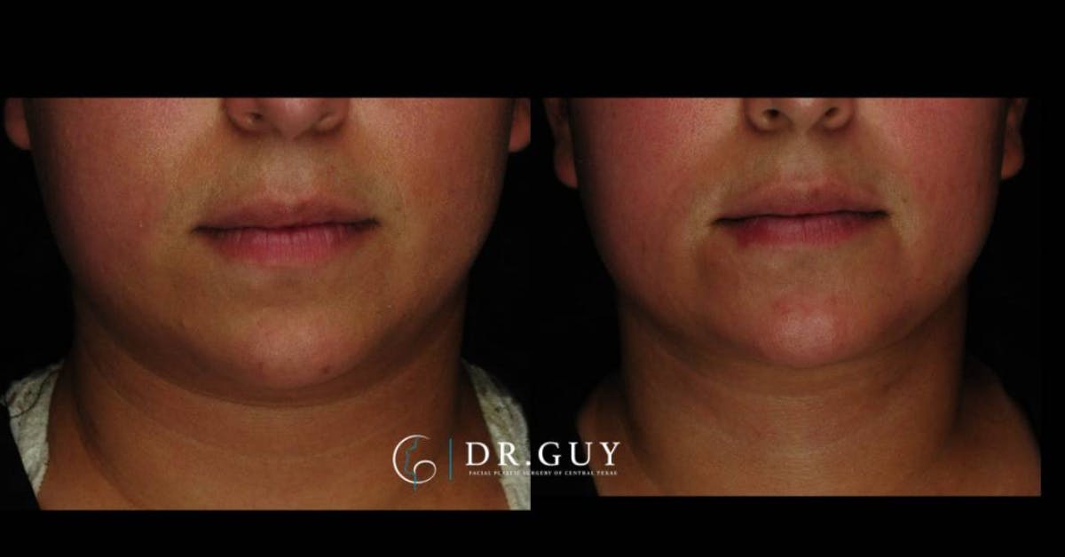 MyEllevate Before & After Gallery - Patient 803412 - Image 1