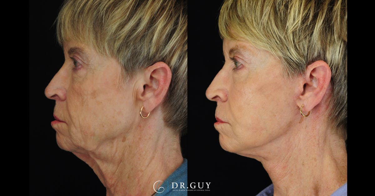 Mini Facelift Before & After Gallery - Patient 108337 - Image 4