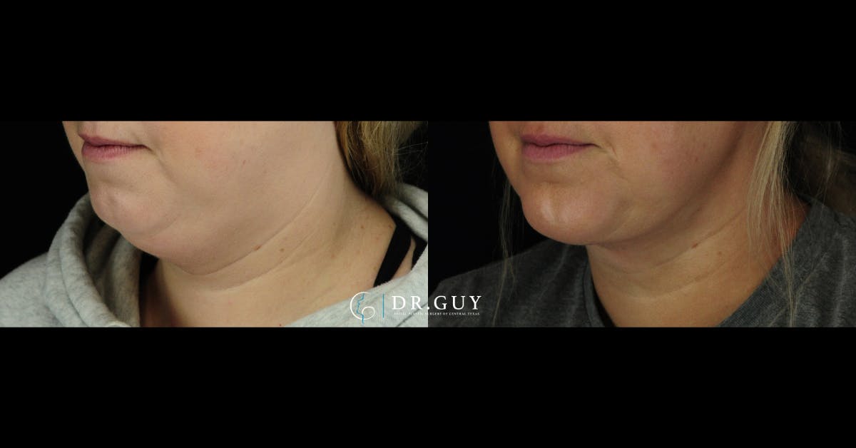 Chin Before & After Gallery - Patient 127249 - Image 2