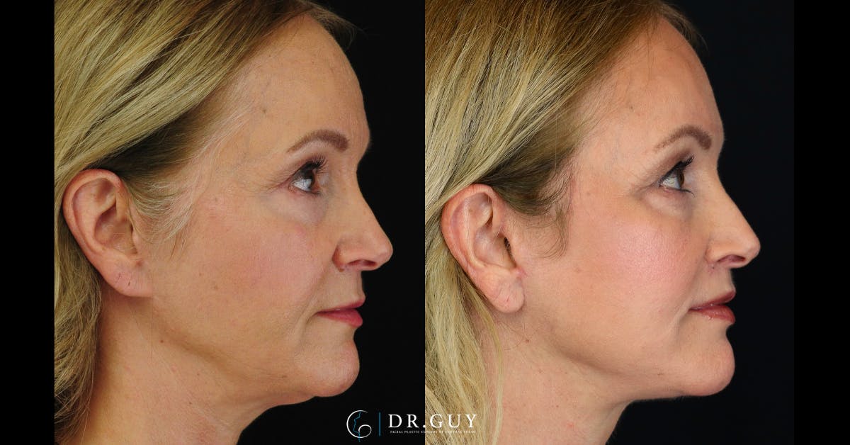 Lip Lift Before & After Gallery - Patient 376573 - Image 5