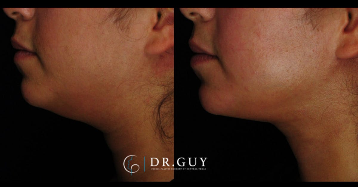 MyEllevate Before & After Gallery - Patient 803412 - Image 2