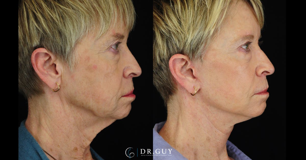 Mini Facelift Before & After Gallery - Patient 108337 - Image 5