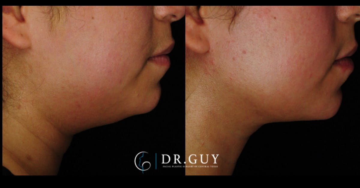 MyEllevate Before & After Gallery - Patient 803412 - Image 3