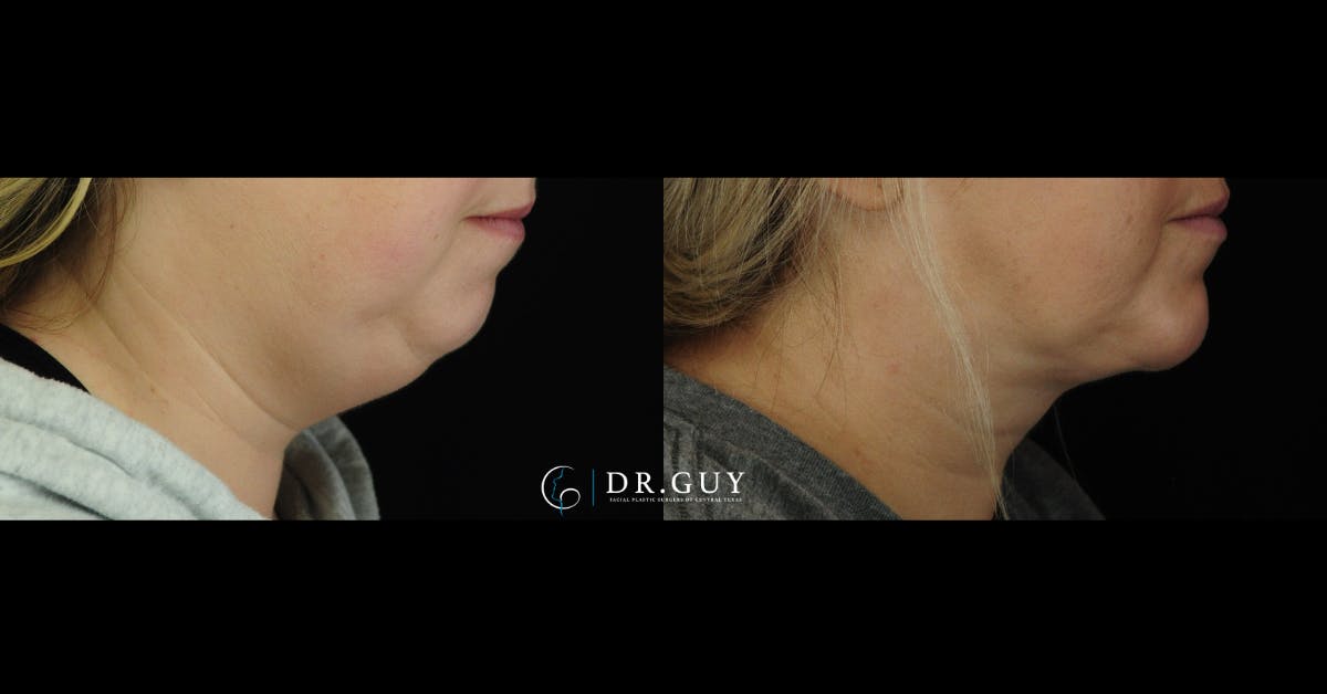 Chin Before & After Gallery - Patient 127249 - Image 4