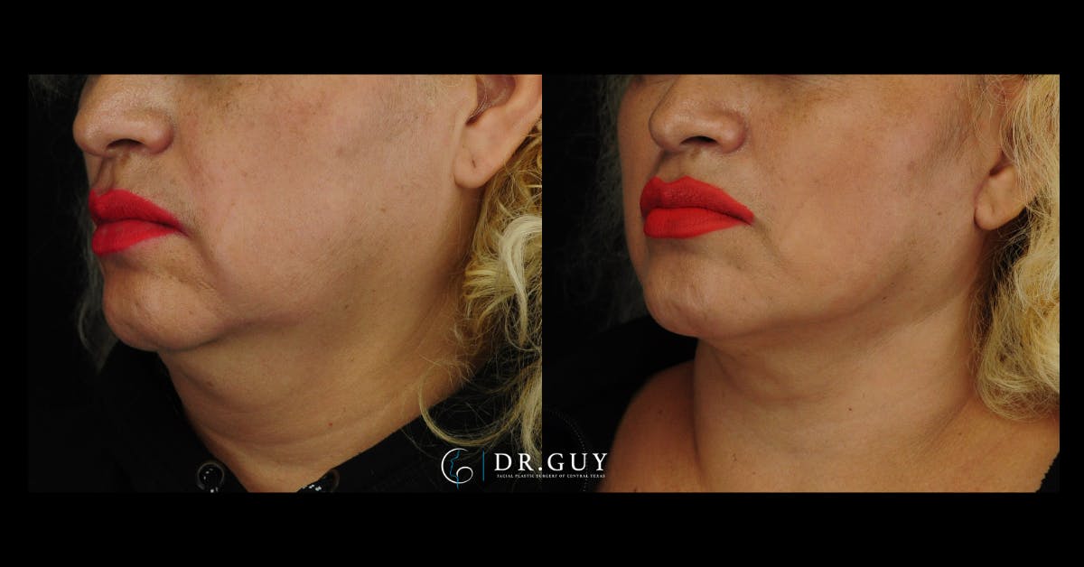 Mini Facelift Before & After Gallery - Patient 107169 - Image 1