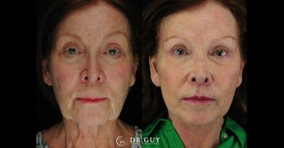 Lip Lift Before & After Gallery - Patient 269556 - Image 1