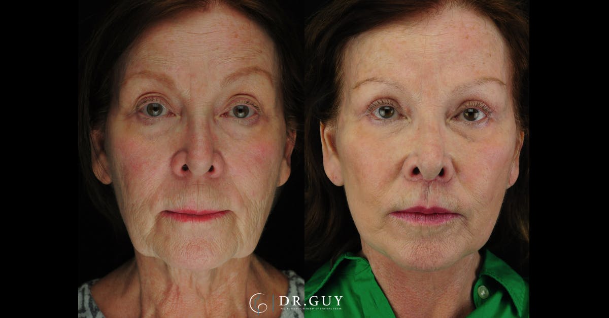 Lip Lift Before & After Gallery - Patient 269556 - Image 1