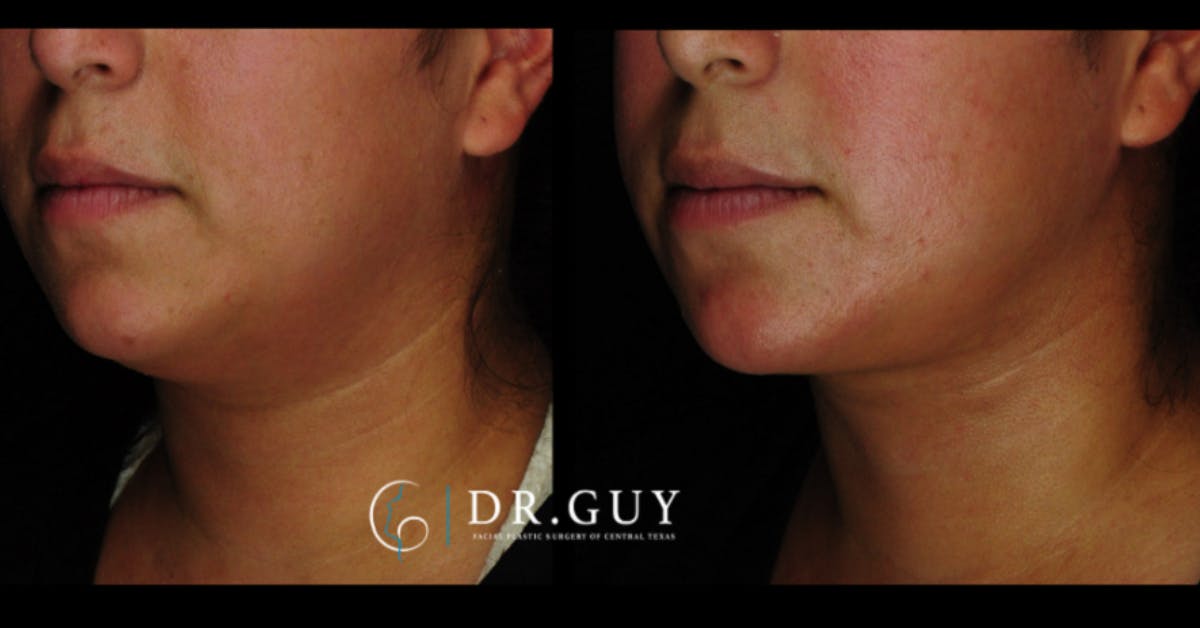 MyEllevate Before & After Gallery - Patient 803412 - Image 4