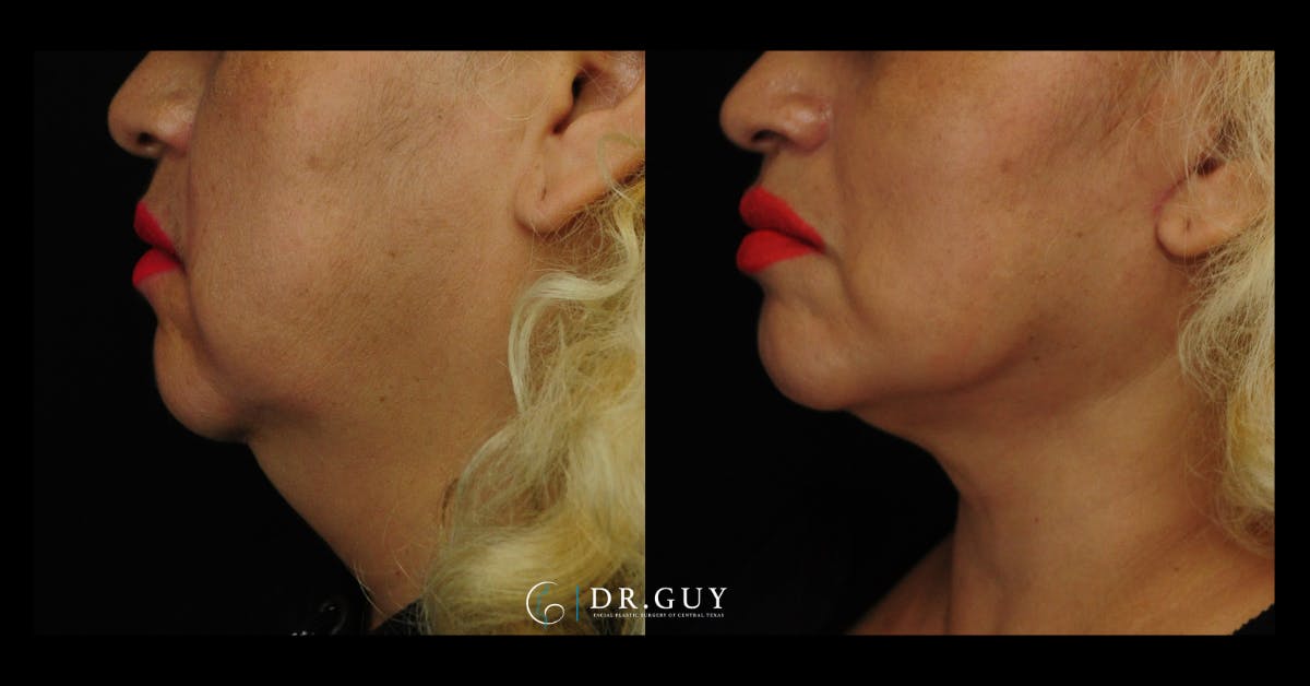 Mini Facelift Before & After Gallery - Patient 107169 - Image 2