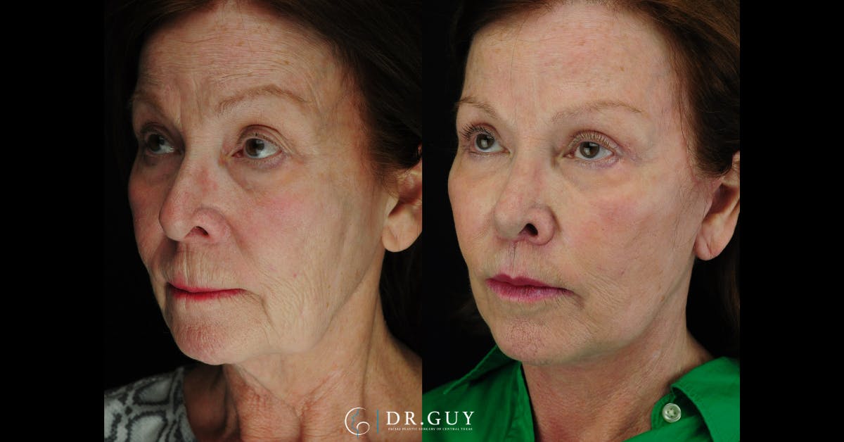 Lip Lift Before & After Gallery - Patient 269556 - Image 2