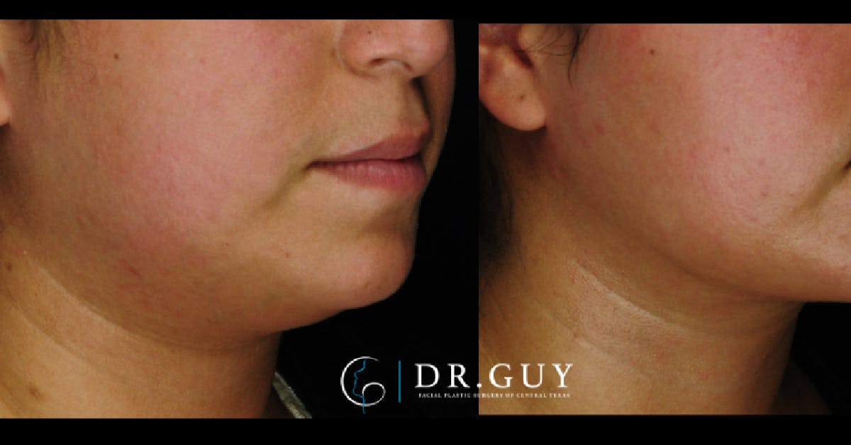 MyEllevate Before & After Gallery - Patient 803412 - Image 5