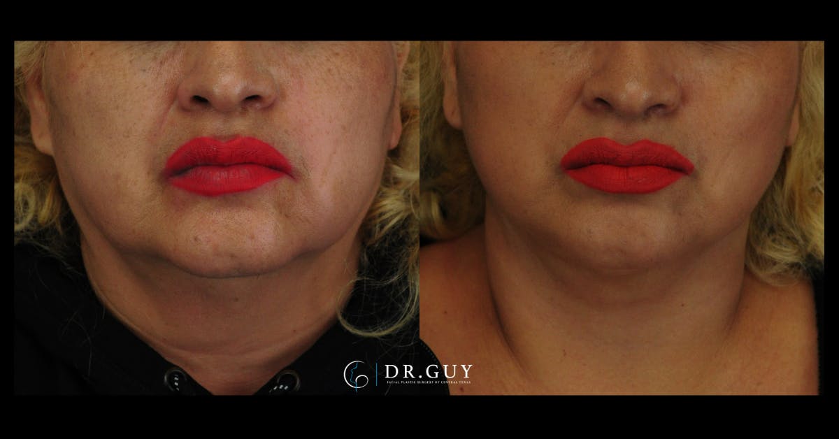Mini Facelift Before & After Gallery - Patient 107169 - Image 3