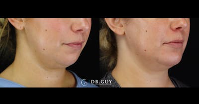 Chin Before & After Gallery - Patient 505561 - Image 1
