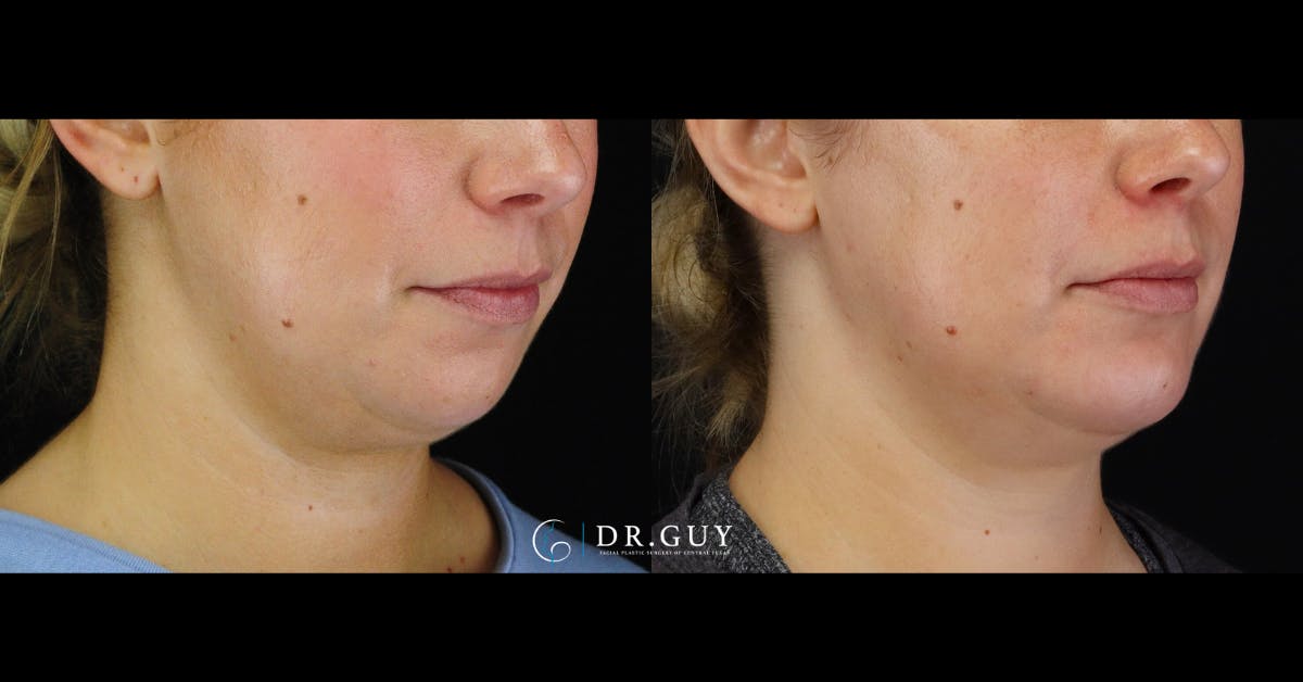 Chin Before & After Gallery - Patient 505561 - Image 1