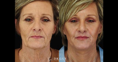 Lip Lift Before & After Gallery - Patient 210418 - Image 1