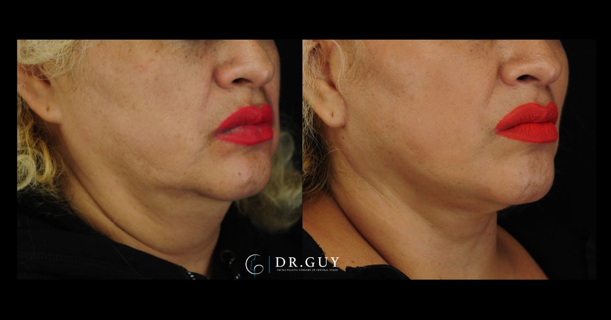 Mini Facelift Before & After Gallery - Patient 107169 - Image 4