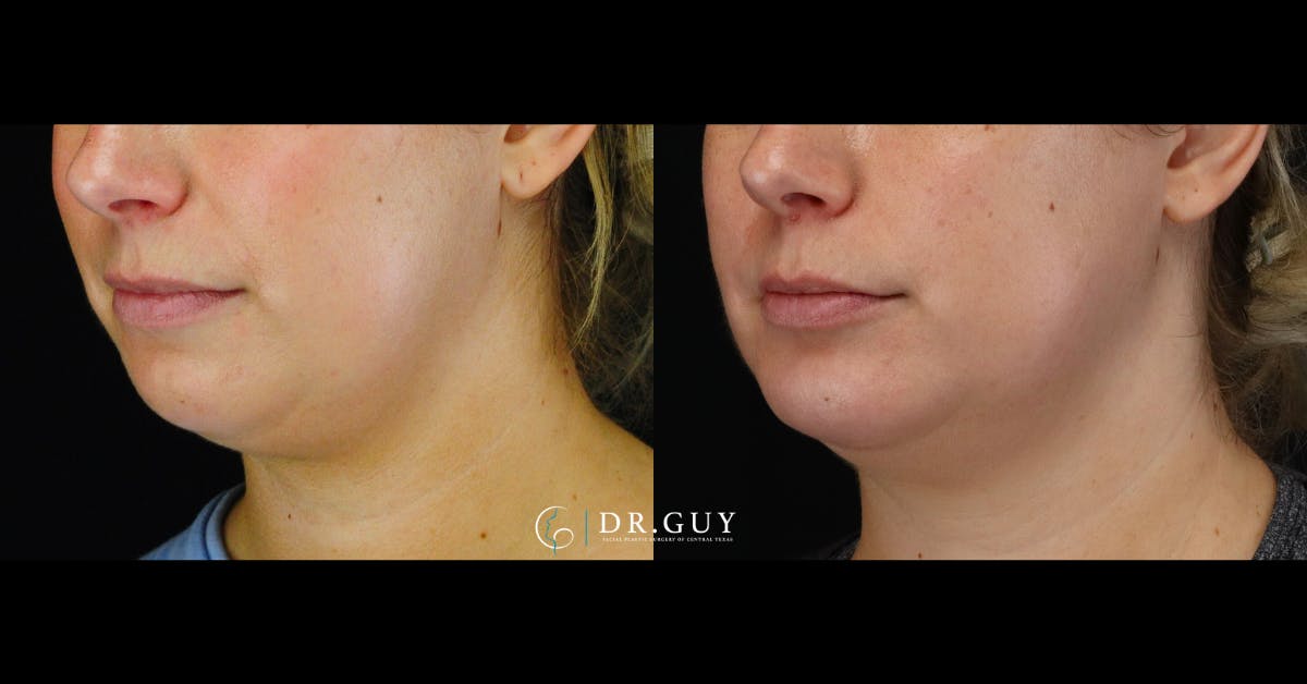 Chin Before & After Gallery - Patient 505561 - Image 2