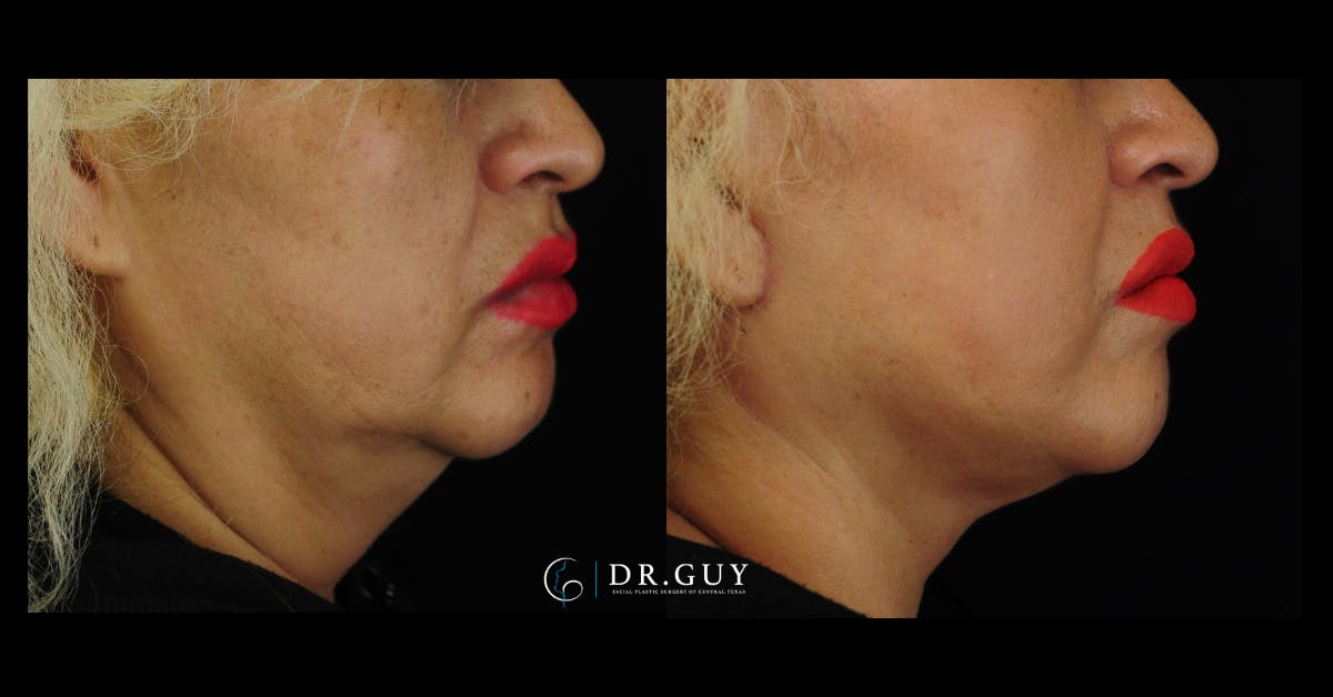 Mini Facelift Before & After Gallery - Patient 107169 - Image 5