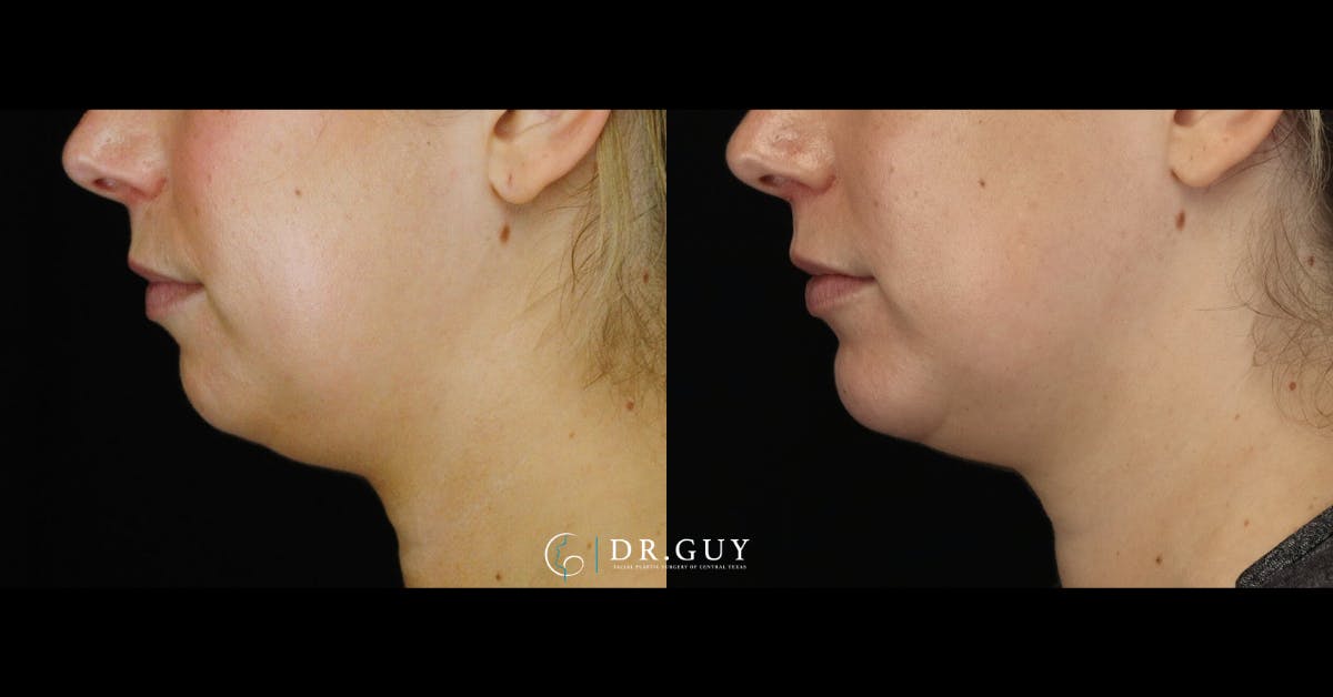 Chin Before & After Gallery - Patient 505561 - Image 3