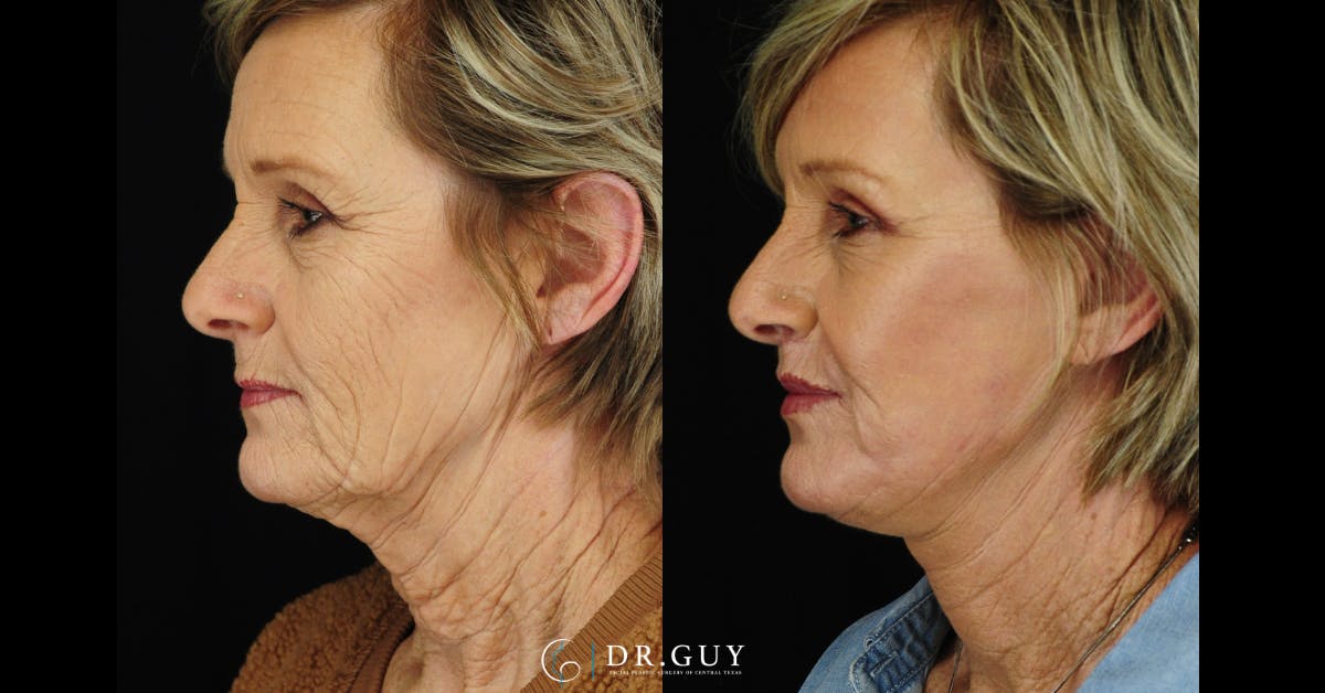 Lip Lift Before & After Gallery - Patient 210418 - Image 3