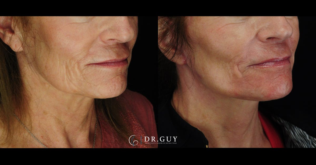 Mini Facelift Before & After Gallery - Patient 222972 - Image 1