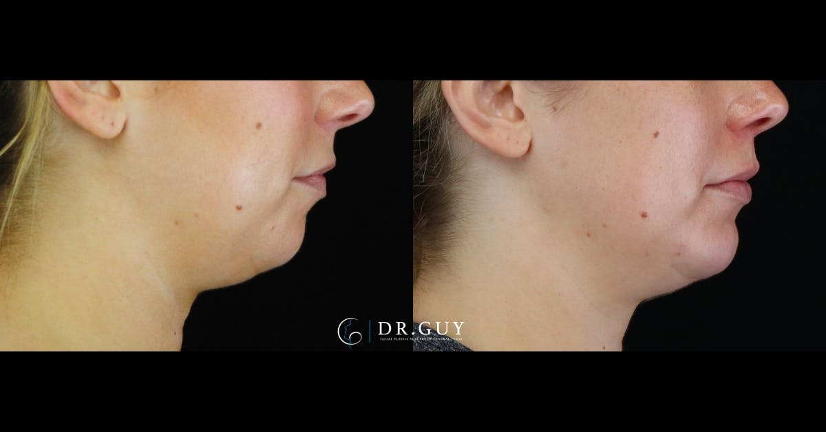 Chin Before & After Gallery - Patient 505561 - Image 4
